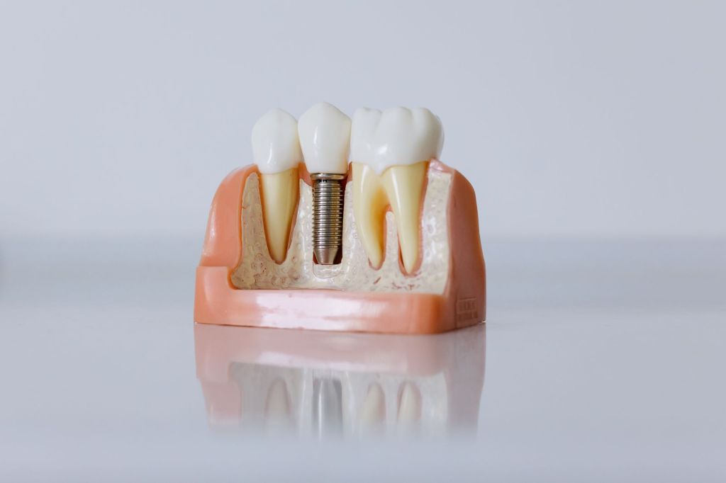 Modelo de implante dental con corona